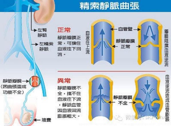 關(guān)于2021年征兵精索靜脈曲張標(biāo)準(zhǔn)的探討，2021年征兵精索靜脈曲張標(biāo)準(zhǔn)深度解析