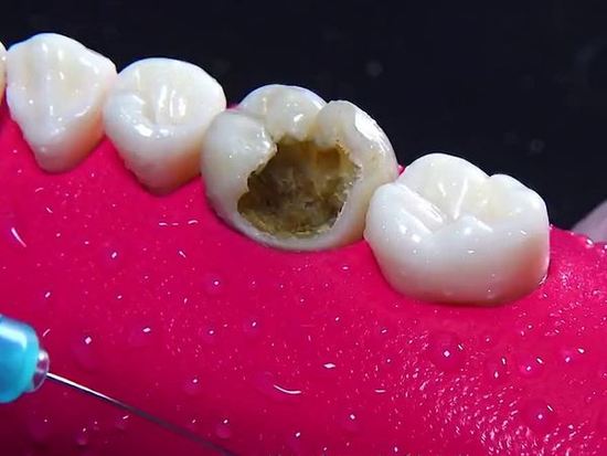 牙齒疼痛，如何應(yīng)對(duì)牙爛大窟窿帶來的困擾，牙齒爛大窟窿引發(fā)疼痛，應(yīng)對(duì)方法解析