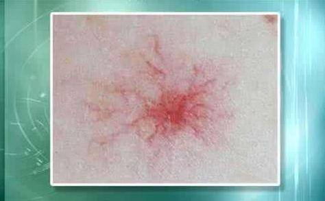 肝癌身上出現(xiàn)紅點(diǎn)圖片，癥狀解析與關(guān)注，肝癌身上紅點(diǎn)解析，癥狀、圖片及關(guān)注重點(diǎn)