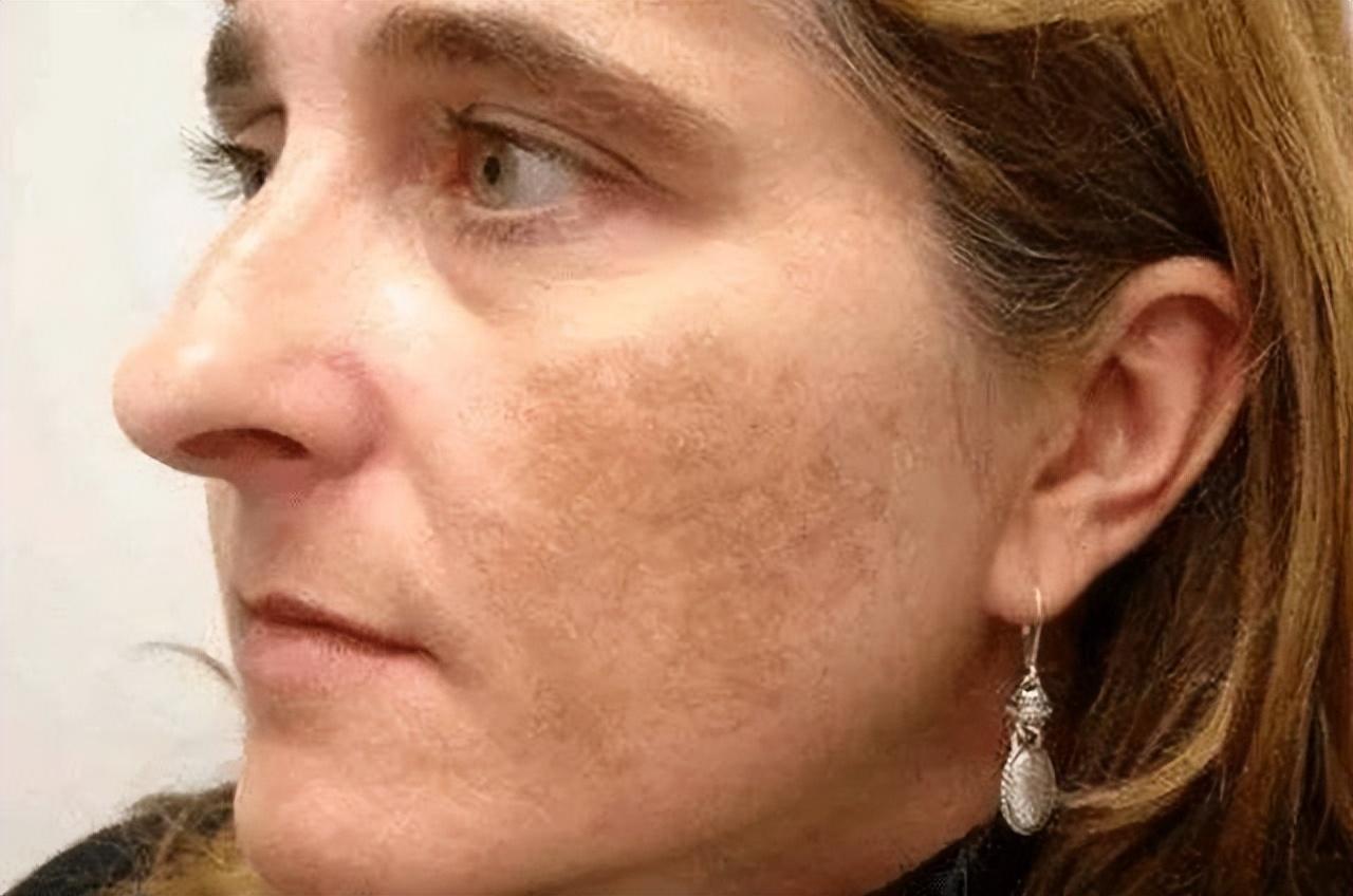 如何有效去除老年斑——全方位指南，全方位指南，如何有效去除老年斑