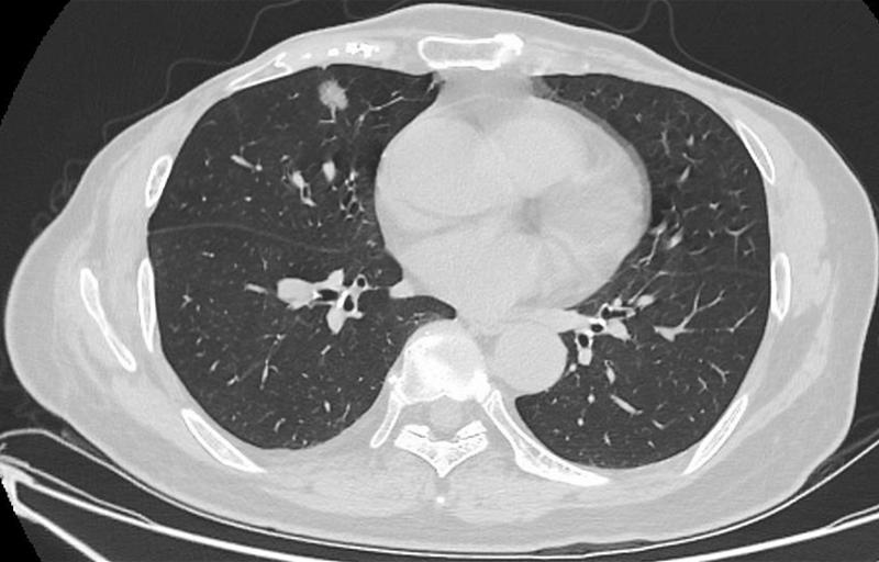 肺結(jié)節(jié)最佳治療方法，全面解析與你的健康之路，肺結(jié)節(jié)最佳治療方法詳解，為您的健康之路指引方向